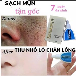 Kem Erythromycin Nhật Bản NH45.